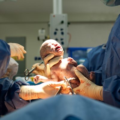 Baby being born via Caesarean Section coming out